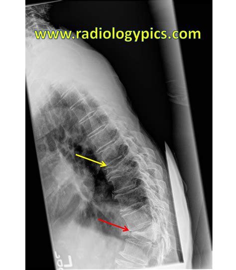 compression fracture of thoracic vertebra